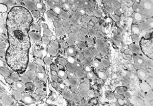 M,35y. | duodenum … lipid malabsorption - susp. hypo-beta-lipoproteinemia M,35y. | duodenum … lipid malabsorption - susp. hypo-beta-lipoproteinemia